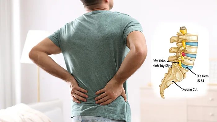 Thoát Vị Đĩa Đệm Có Nên Massage? Góc Nhìn Chuyên Sâu Từ Y Học Cổ Truyền Đến Thực Tiễn Trị Liệu thoát vị đĩa đệm có nên massage